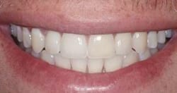 Picture of a smile with New Orleans dental implants from Dr. Delaune of Metairie.
