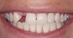 Picture of a patient's smile before receiving New Orleans dental implants from Dr. Delaune of Metairie.
