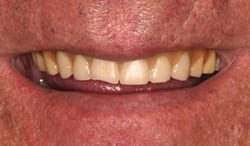 New Orleans dentures before picture from Dr. Duane Delaune