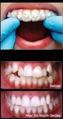 Photo of Six Month Smiles braces, which are available from New Orleans cosmetic dentist Dr. Duane Delaune.