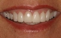 Picture of porcelain crowns. In New Orleans, get porcelain crowns from Dr. Delaune.