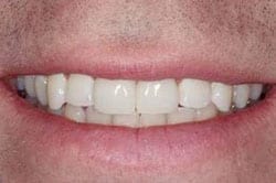 After picture of beautiful New Orleans tooth bonding by Dr. Delaune of Metairie.