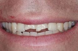 Before picture for New Orleans tooth bonding by Dr. Delaune of Metairie