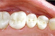 Picture of New Orleans white fillings.