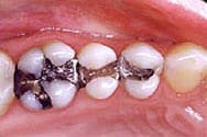 Picture of amalgam fillings before replaced with New Orleans white fillings.