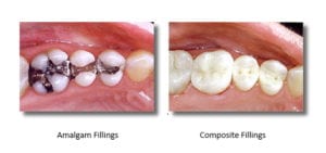Image left of silver amalgam fillings loaded with mercury. Image right: mercury-free composite fillings