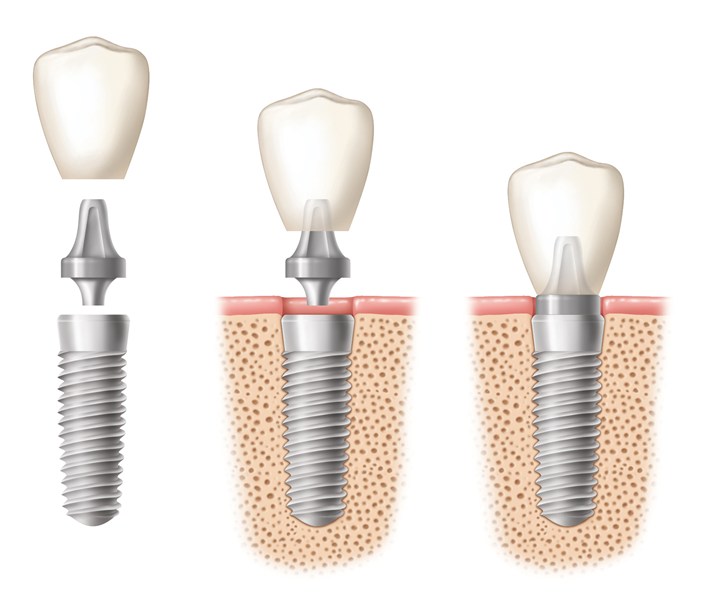 Abutment and crown being placed on dental implants