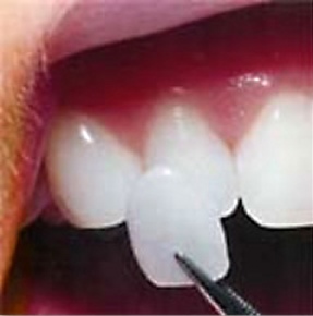 A woman getting a porcelain veneer placed on her teeth