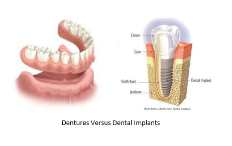 dentures and dental implants