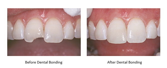 before and after dental bonding for a chipped tooth