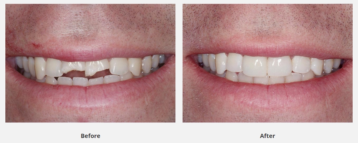 before and after dental bonding for broken teeth