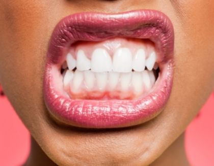 Woman's mouth clenching teeth - for info on tooth sensitivity from Metairie dentist Duane Delaune, DDS
