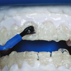 Zoom whitening gel being applied to teeth
