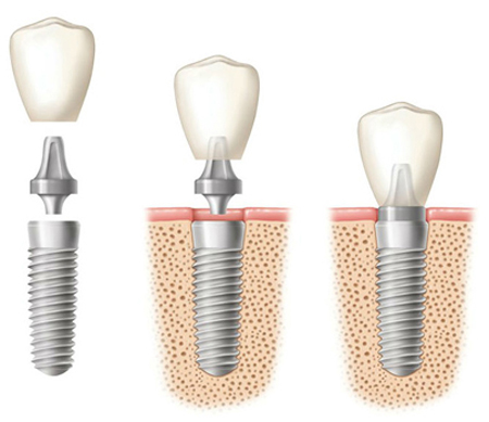 Diagram of three phases of dental implants for info about dental anxiety and implants