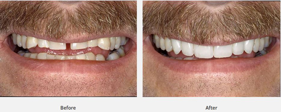 Before-and-after dental crowns photo