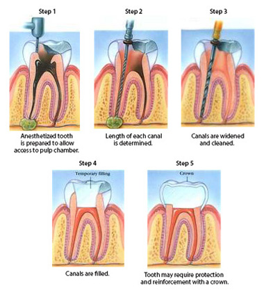 Diagram of root canal phases, including numbing the tooth, widening, cleaning, and filling canals and attaching a dental crown.