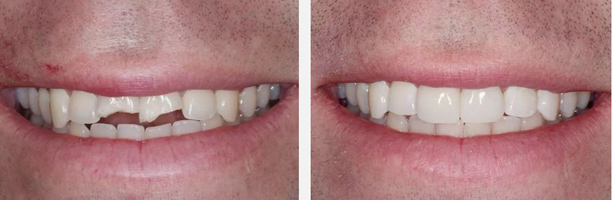 Before and after dental bonding smile