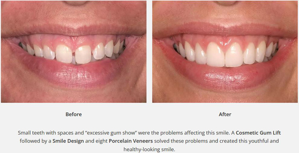 Before-and-after small teeth photos from Dr. Duane Delaune of Metairie, LA