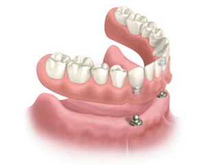 Snap-on denture hovering above the lower gums