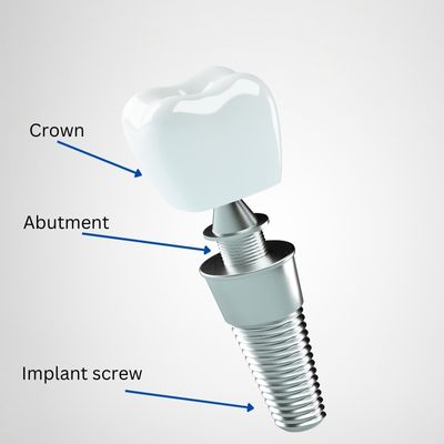 Dental implant with crown, abutment, and implant screw identified