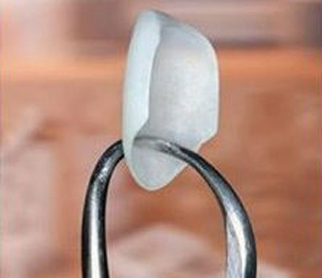 One porcelain veneer held by dental forceps