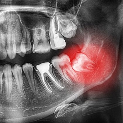 X-ray of a lower impacted widom tooth, for information on how long you can delay removal