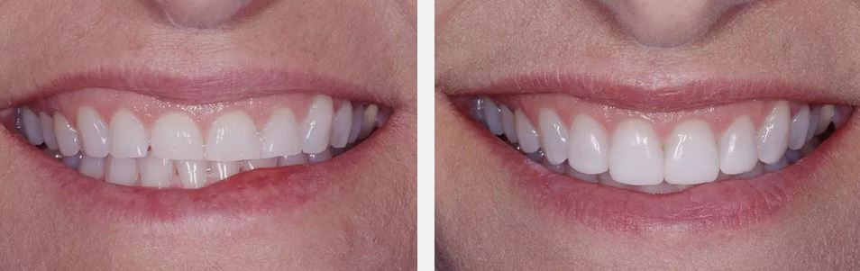 Before and after composite veneers photos
