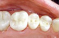 Lower teeth with mercury-free white fillings