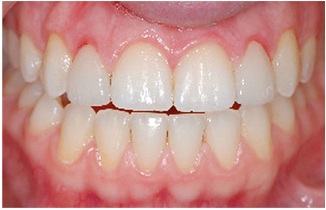 Red, inflamed gums after getting porcelain veneers