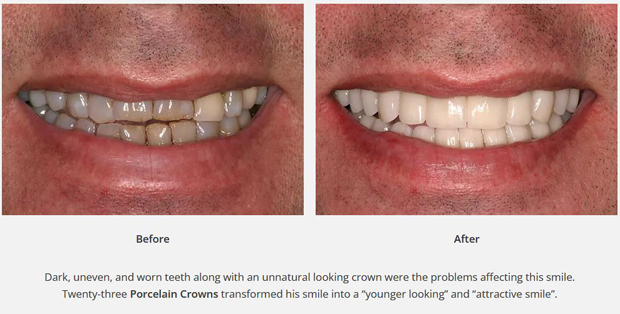 Before and after dark front teeth restored with dental crown photos from Metairie, LA, cosmetic dentist Dr. Delaune