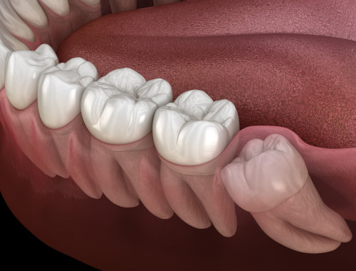 Lower left impacted wisdom tooth