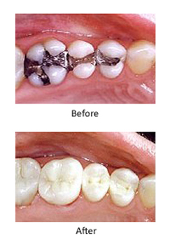 Before and after pictures of amalgam fillings and mercury free composite fillings