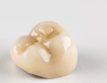 A dental crown for a molar tooth, which can have a cavity beneath it if bacteria leak in