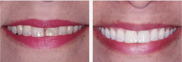 Before and after teeth gap pictures with dental bonding