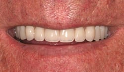 New Orleans dentures after picture from Dr. Duane Delaune
