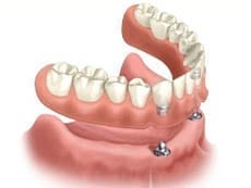 Picture of New Orleans implant dentures that are ball retained.