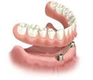 Picture of New Orleans implant dentures that are bar-retained.