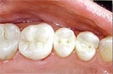 Picture of New Orleans mercury-free fillings after