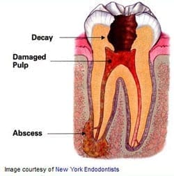 Picture of infected tooth that requires a New Orleans root canal treatment.