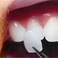 Picture of New Orleans porcelain veneers, which can be obtained from Metairie dentist Dr. Duane Delaune.