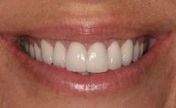 Picture of teeth that had New Orleans tetracycline stains after cosmetic treatment from Dr. Delaune.