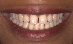 Picture of patient's New Orleans tooth gap that was later closed by Dr. Delaune.