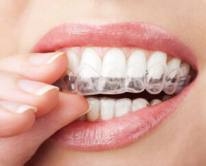 custom-fitted teeth whitening trays