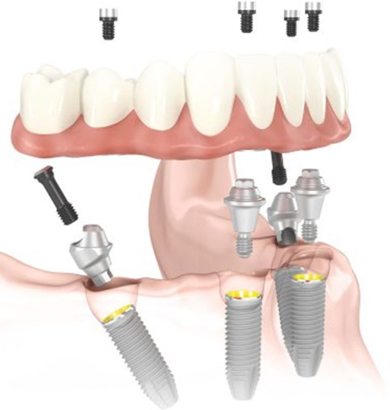 illustration of the position for all-on-4 dental implants