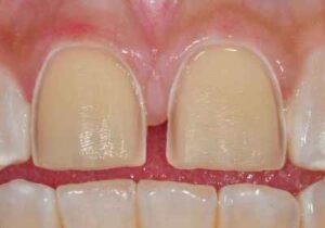 tooth preparation for porcelain veneers.