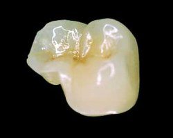 Porcelain onlay for a molar tooth
