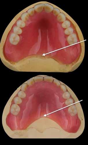 Two upper dentures placed vertically with a shorter palate on the lower denutre