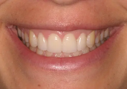 After: Gum Lift, Porcelain Veneers, Dental Bonding