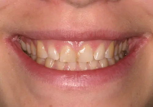 Before: Gum Lift, Porcelain Veneers, Dental Bonding