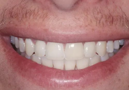 After dental implant: the missing front tooth replaced with a natural-looking crown